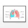 Pneumothorax Anatomical Illustration  Print 100% Australian Made 90x60cm  (Poster)