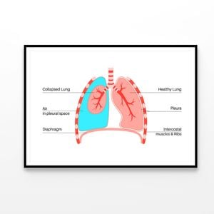 Pneumothorax Anatomical Illustration  Print 100% Australian Made 90x60cm  (Poster)