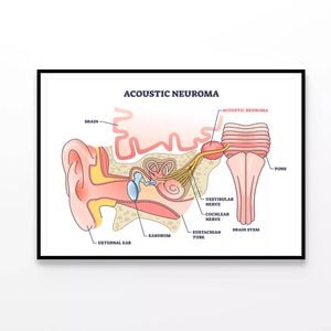 Acoustic Neuroma  Print 100% Australian Made 120x90cm  (Poster)