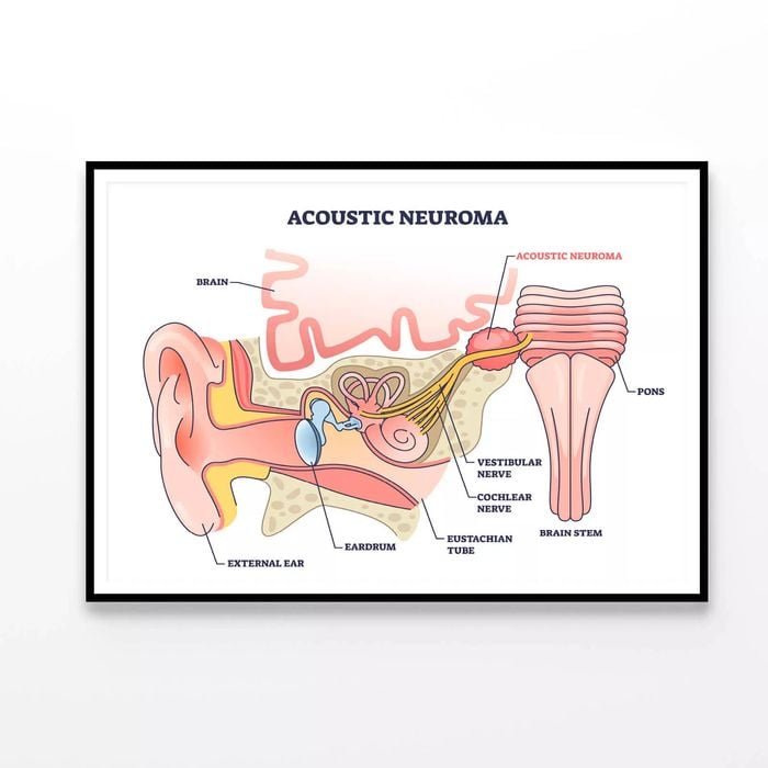 Acoustic Neuroma  Print 100% Australian Made 90x60cm  (Poster)