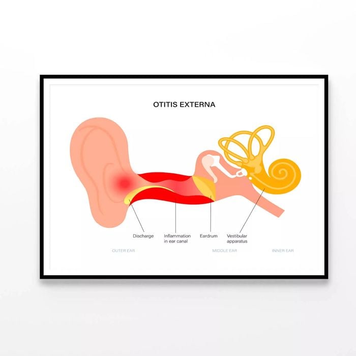 Swimmers Ear Otitis Illustration  Print 100% Australian Made 90x60cm  (Poster)