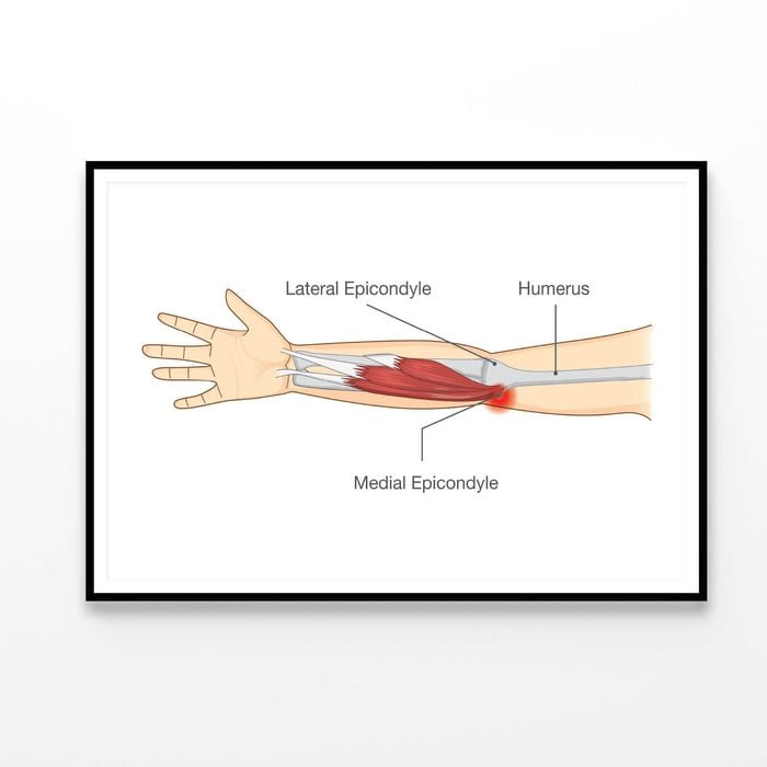 Muscle Injury and Tear in Tendon at Elbow Area  Print 100% Australian Made 90x60cm  (Poster)