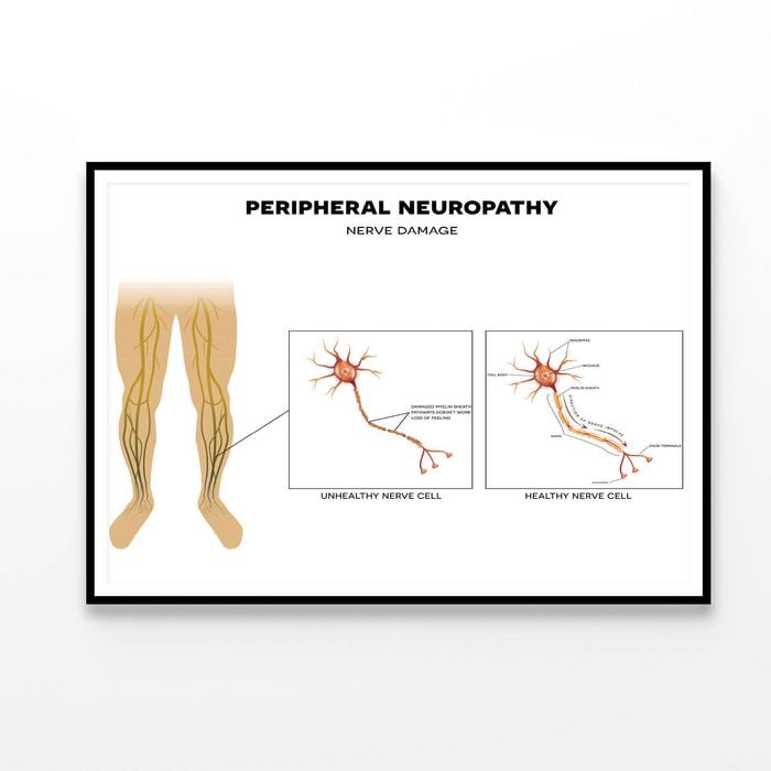Neuropathy, Nerve Damage Illustration  Print 100% Australian Made 90x60cm  (Poster)