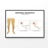 Neuropathy, Nerve Damage Illustration  Print 100% Australian Made 120x90cm  (Poster)