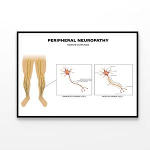 Neuropathy, Nerve Damage Illustration  Print 100% Australian Made 120x90cm  (Poster)
