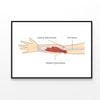 Muscle Injury and Tear in Tendon at Elbow Area  Print 100% Australian Made 120x90cm  (Poster)