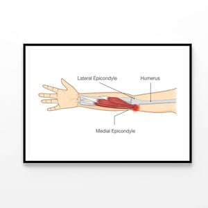Muscle Injury and Tear in Tendon at Elbow Area  Print 100% Australian Made 120x90cm  (Poster)